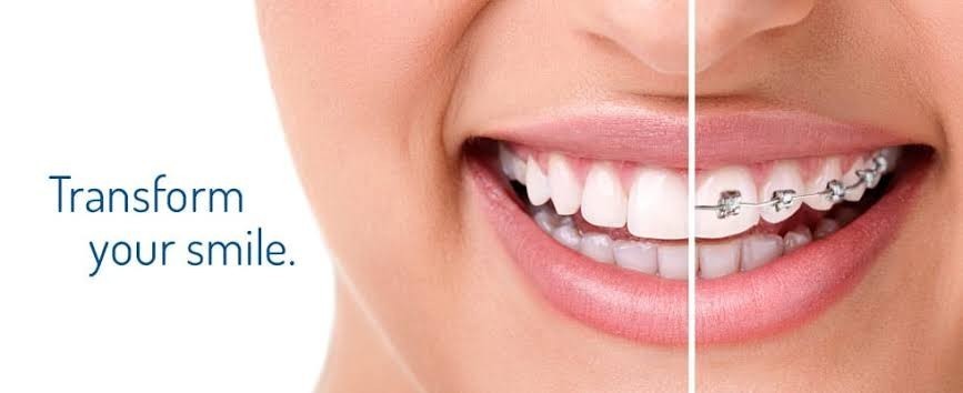 Cosmetic Dentistry in Vizag Invisalign in vizag  Dental Implants Vizag